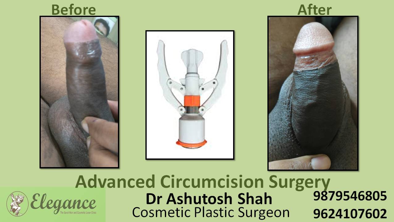 Advance Circumcision Surgery, Selvasa, Gujarat, India