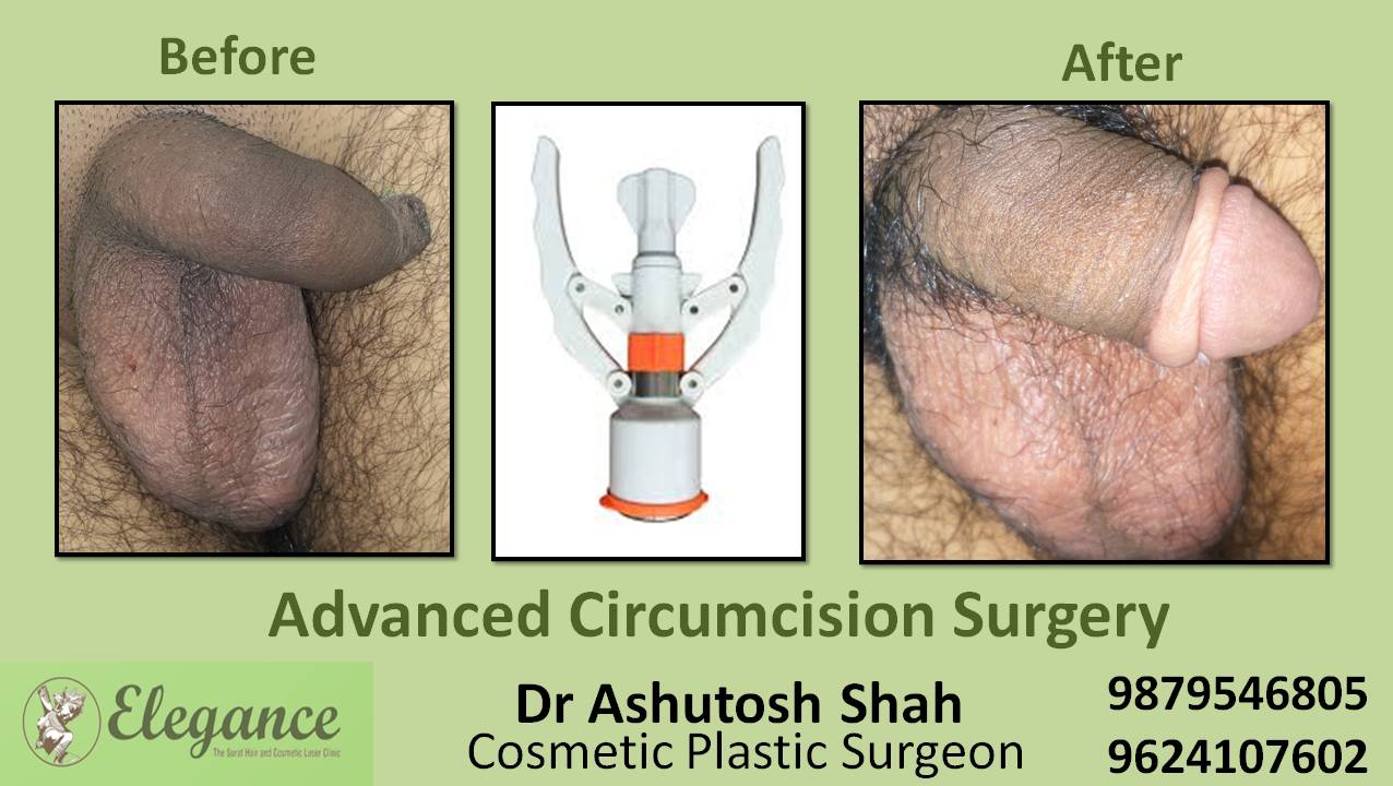 Advance Circumcision Surgery, Surat, Gujarat, India