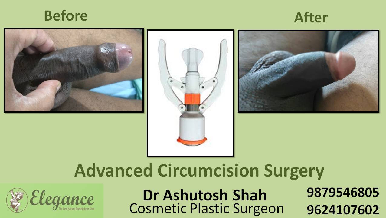 Advance Circumcision Surgery, Vapi, Gujarat, India