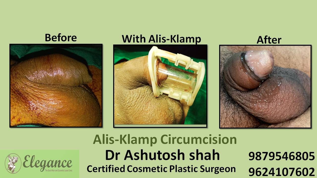 Alisklamp Circumcision Surgery