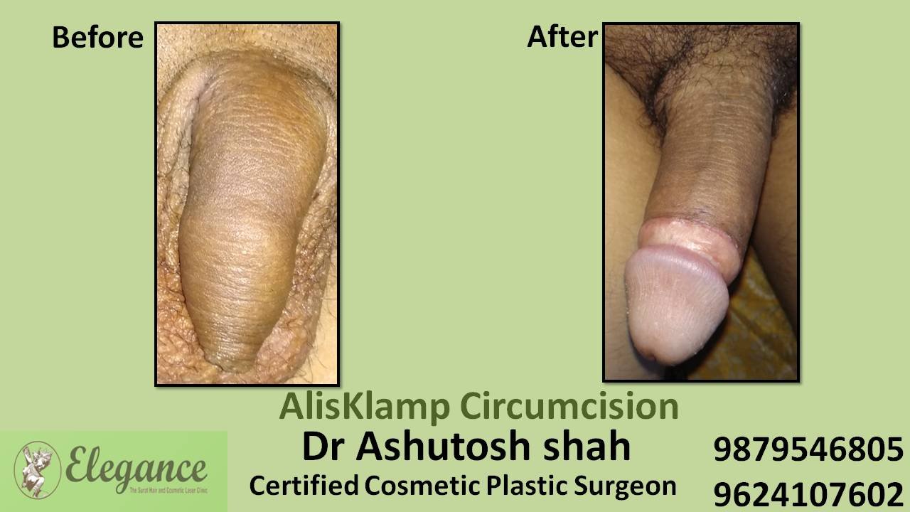 Alisklamp Circumcision Surgery