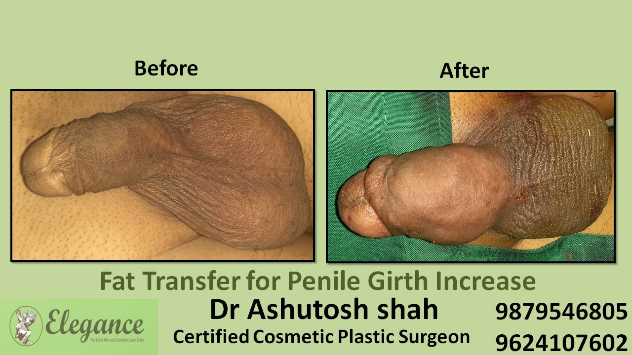 Penile Girth Increase (Fat Grafting) in Surat (Gujarat) India