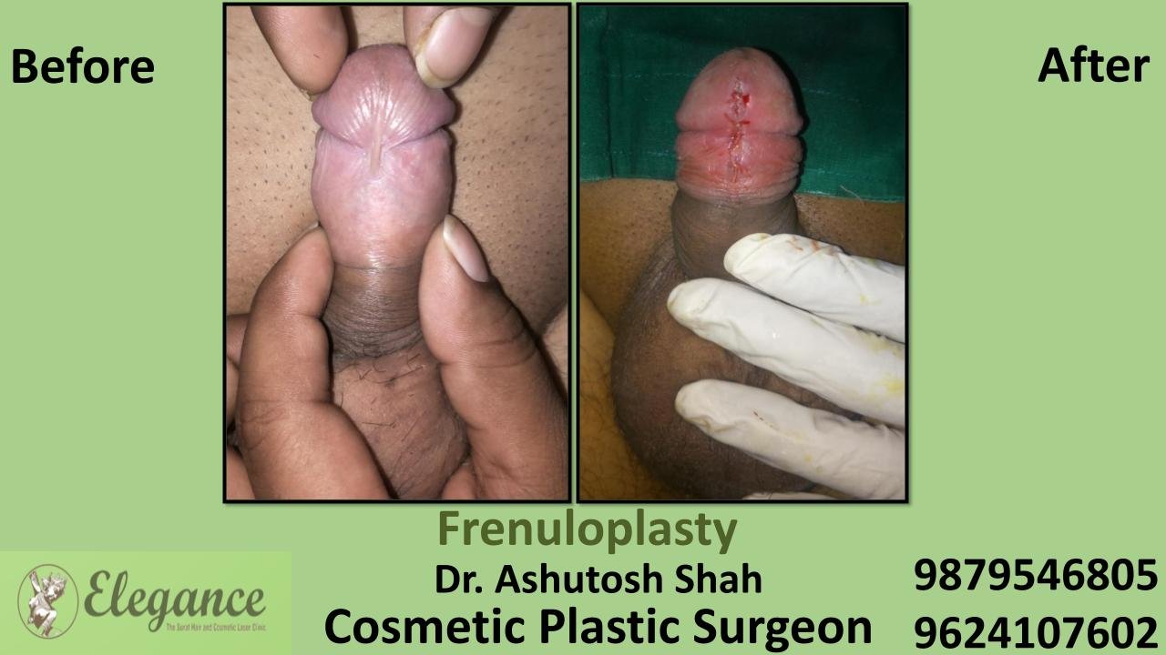 Best Frenuloplasty in Navsari, Surat, Gujarat