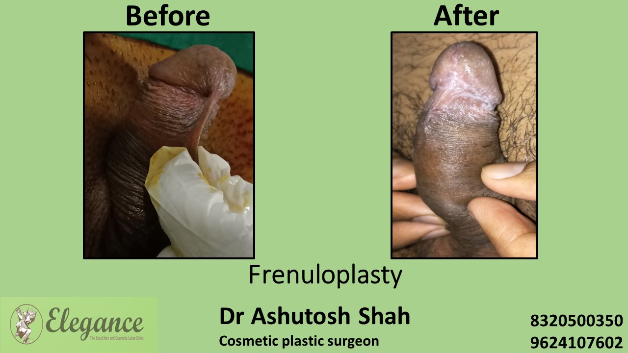 Frenuloplasty in Adajan, Surat, Gujarat