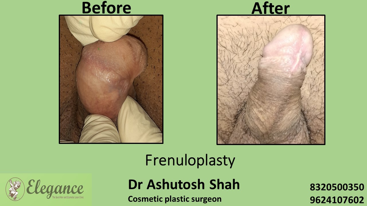 Frenuloplasty in Surat, Bardoli, Gujarat