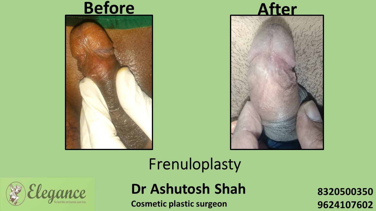 Frenuloplasty in Surat, Bharuch, Gujarat