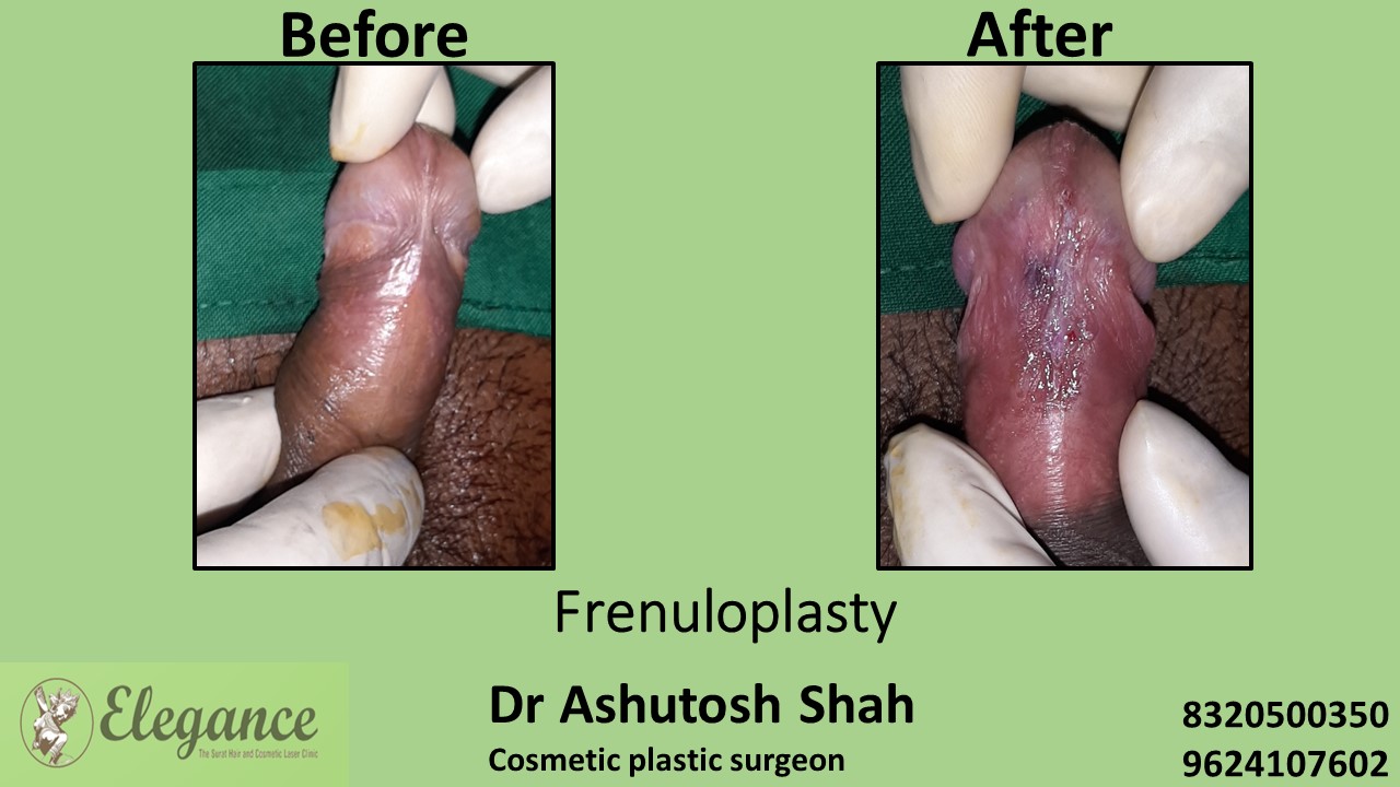 Frenuloplasty in Surat, Kosamba, Gujarat