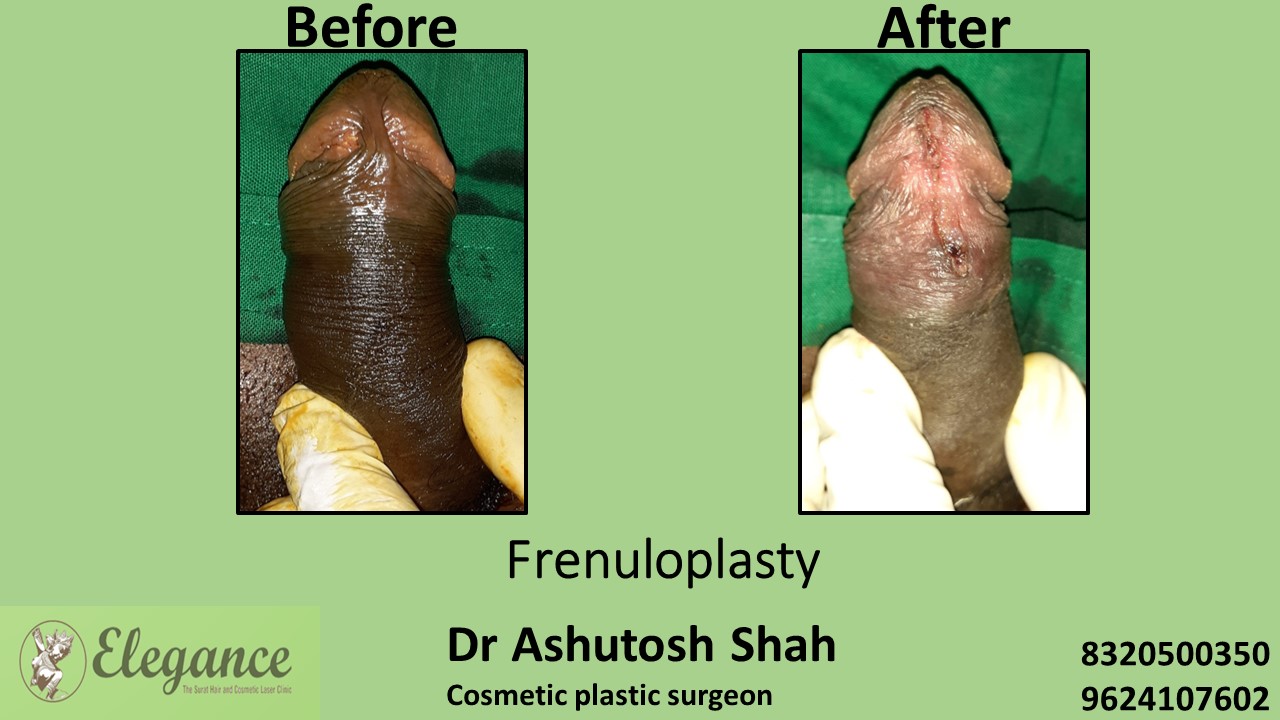 Frenuloplasty in Surat, Navsari, Gujarat