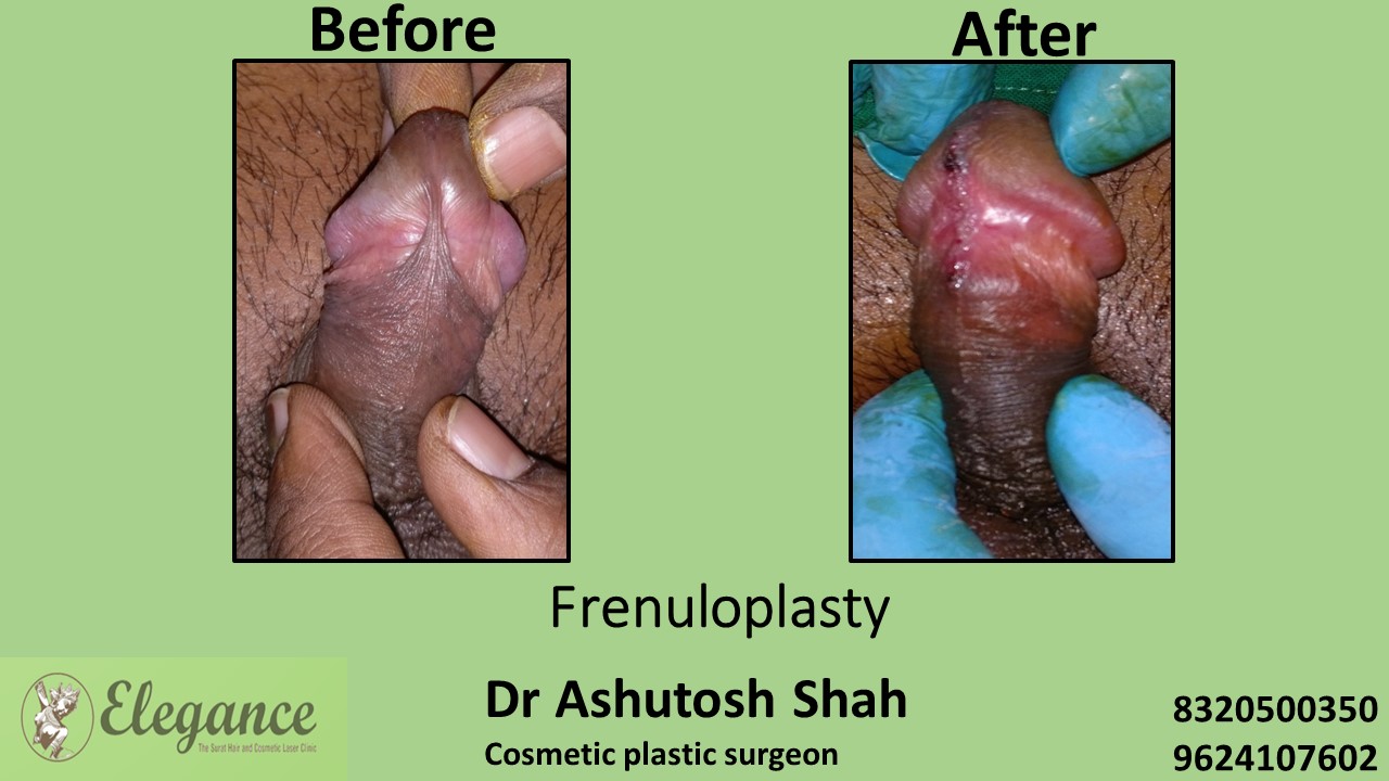 Frenuloplasty in Surat, Valsad, Gujarat