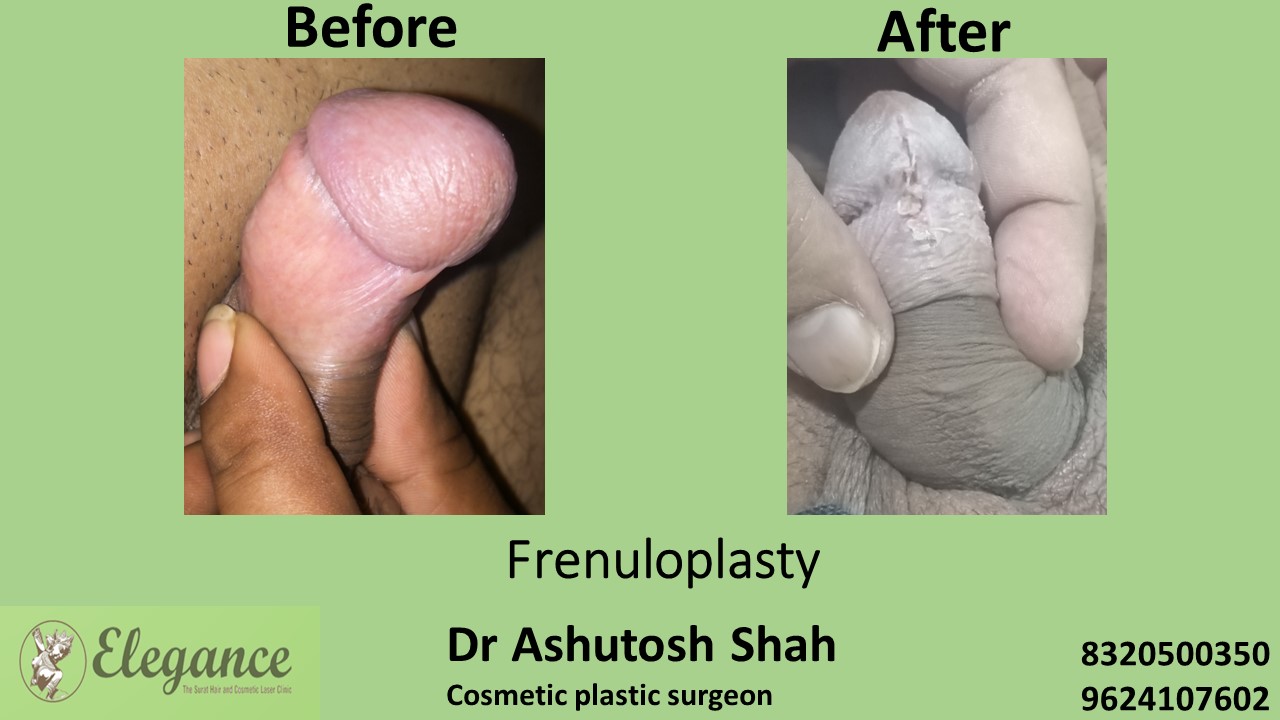 Frenuloplasty in Surat, Vapi, Gujarat