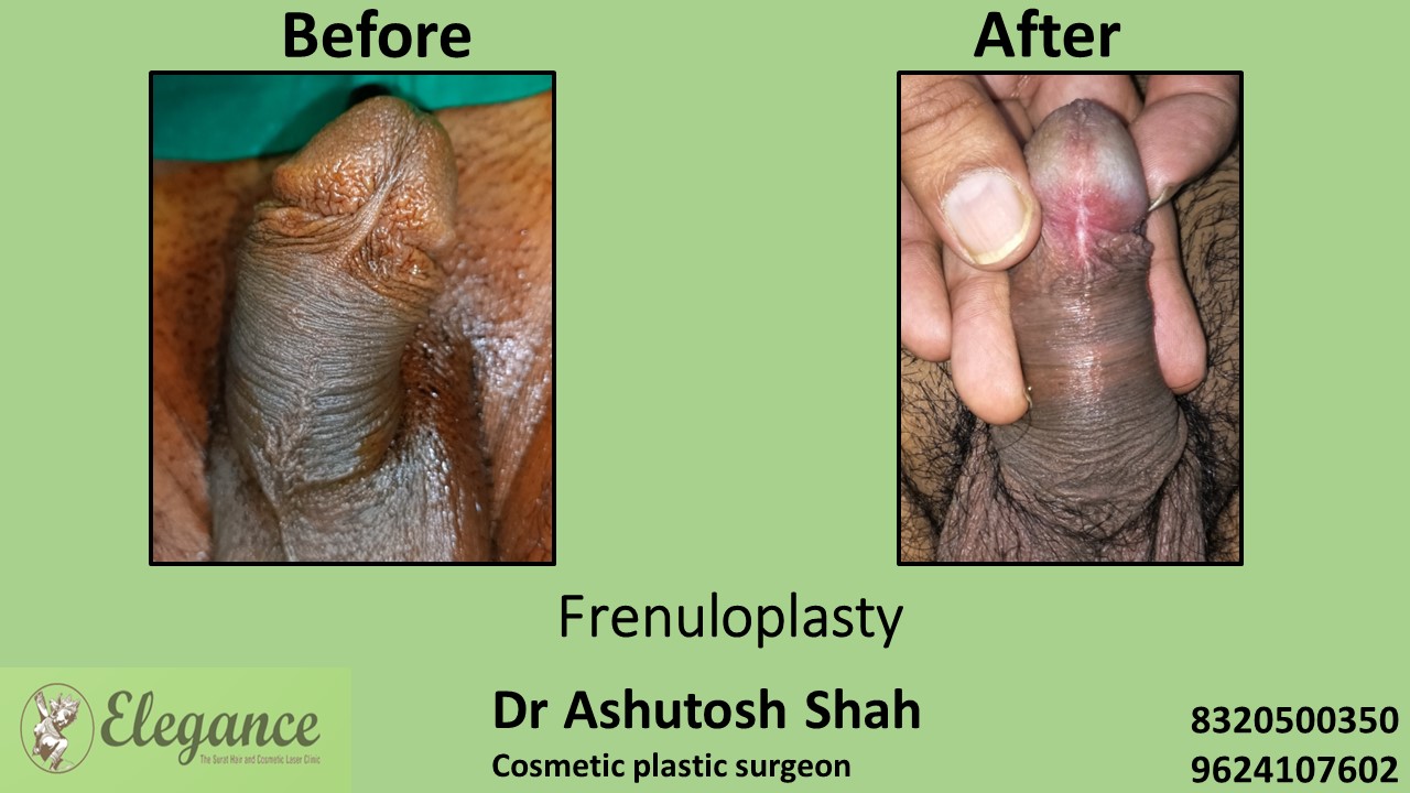 Stitched Frenuloplasty in Surat, Navsari, Gujarat