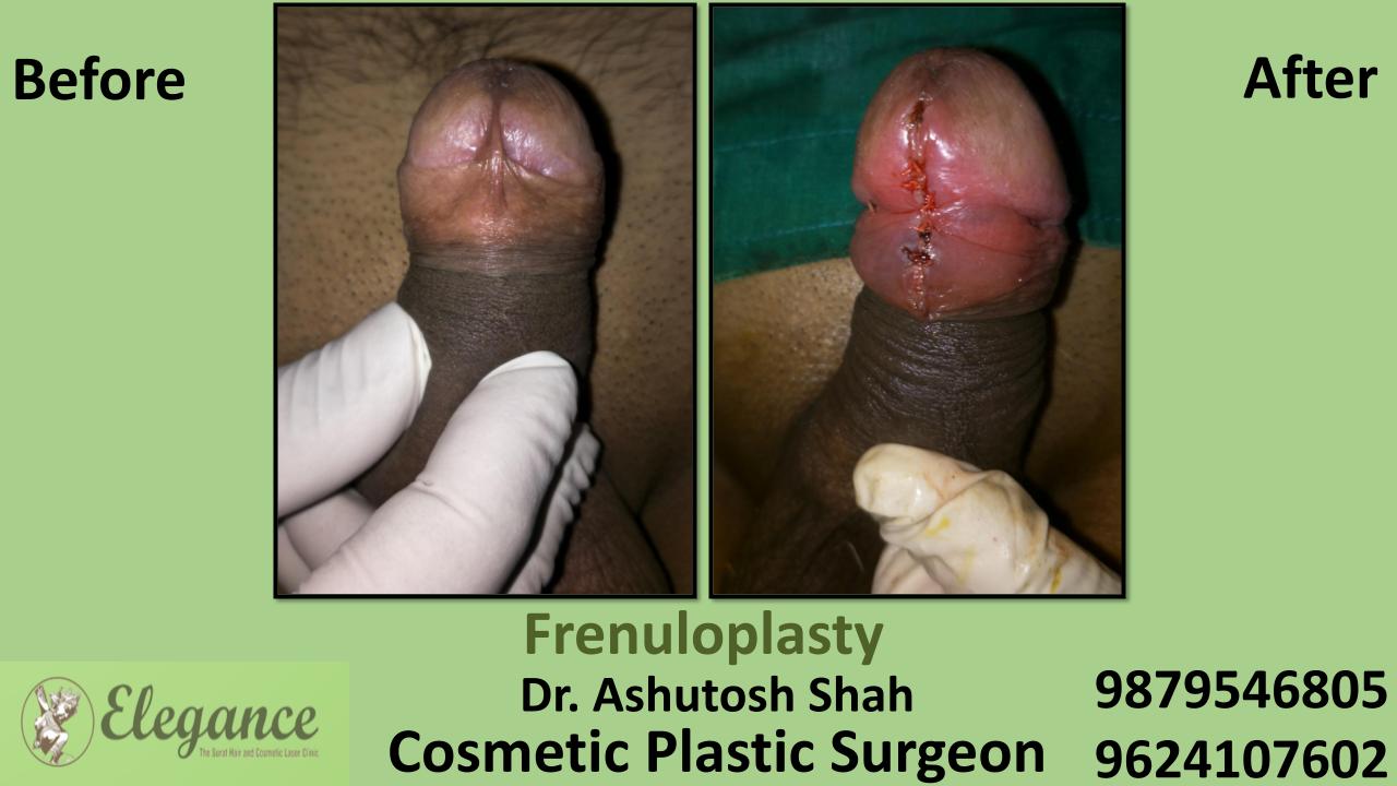Frenuloplasty at Low cost in Surat, Gujarat
