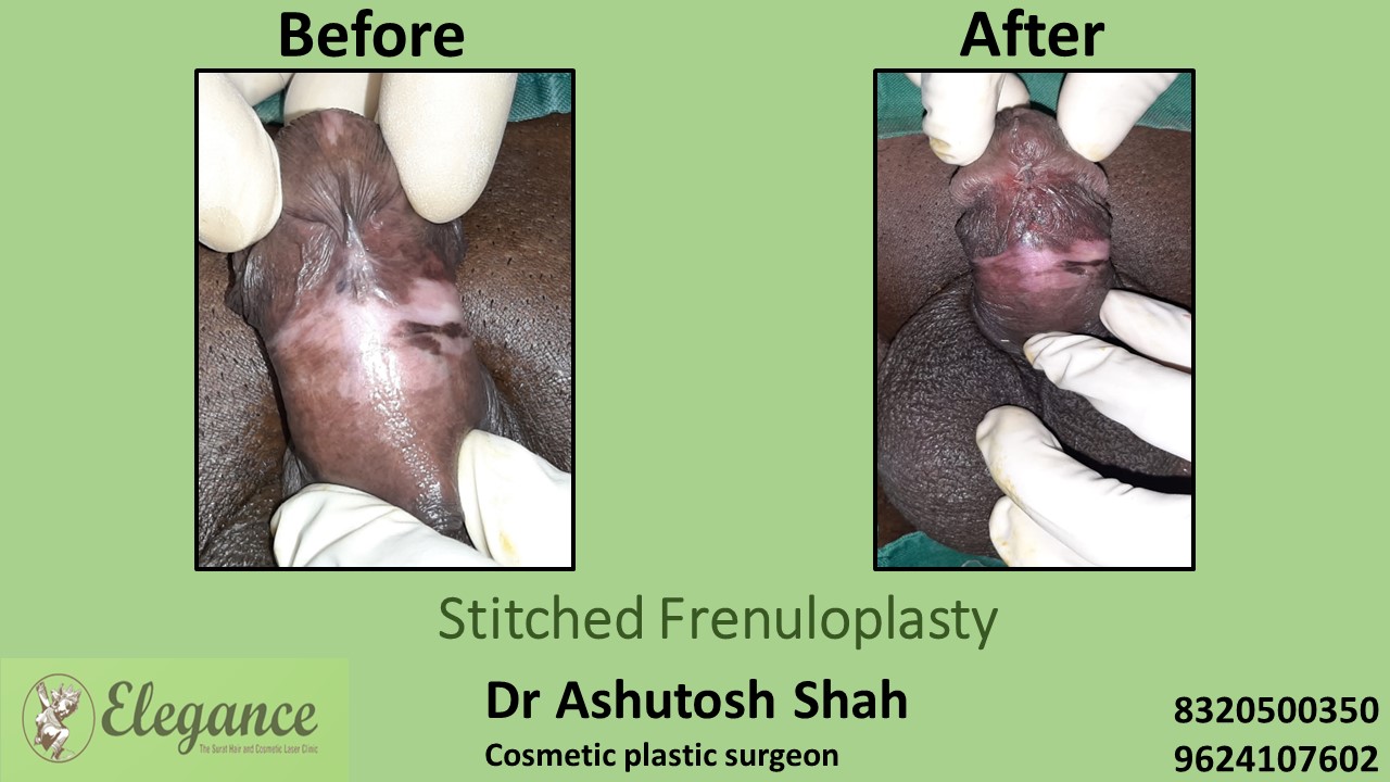 Stitched Frenuloplasty in Surat, Valsad, Gujarat