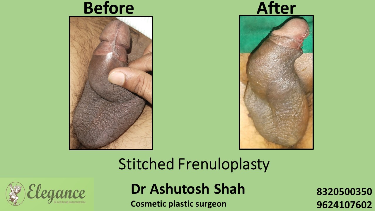 Stitched Frenuloplasty in Surat, Vapi, Gujarat