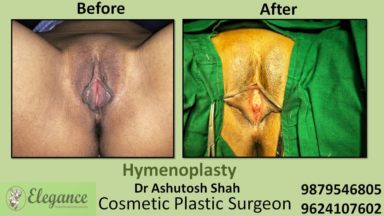 Hymenoplasty Surgery in Surat, Gujarat (India)