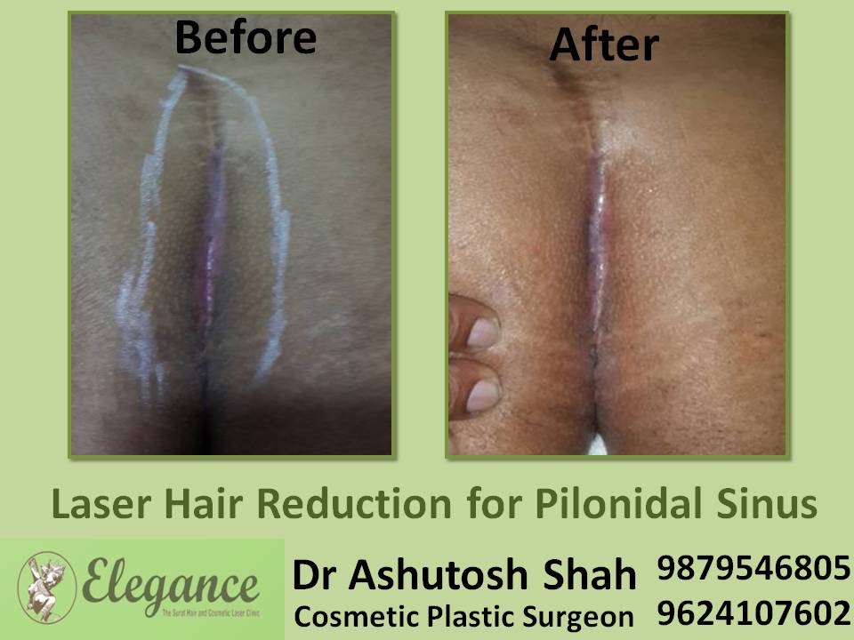 Permanent Hair Removal From Pubic Area in Surat, Gujarat (India)