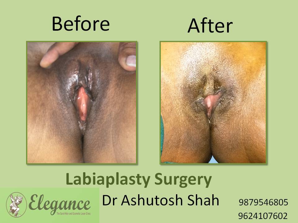 Labiaplasty Surgery in Surat, Gujarat (India)