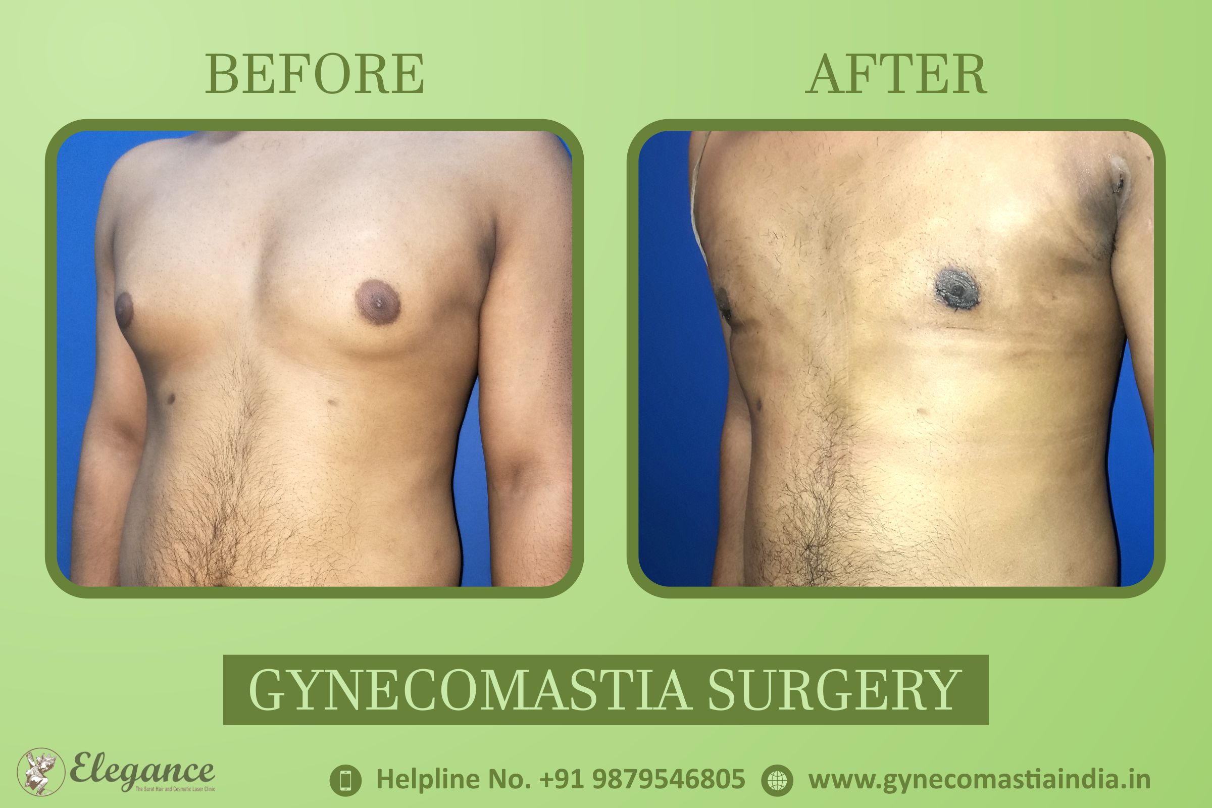 Experts for Male Breast Reduction Surgery in Bardoli, Gujarat
