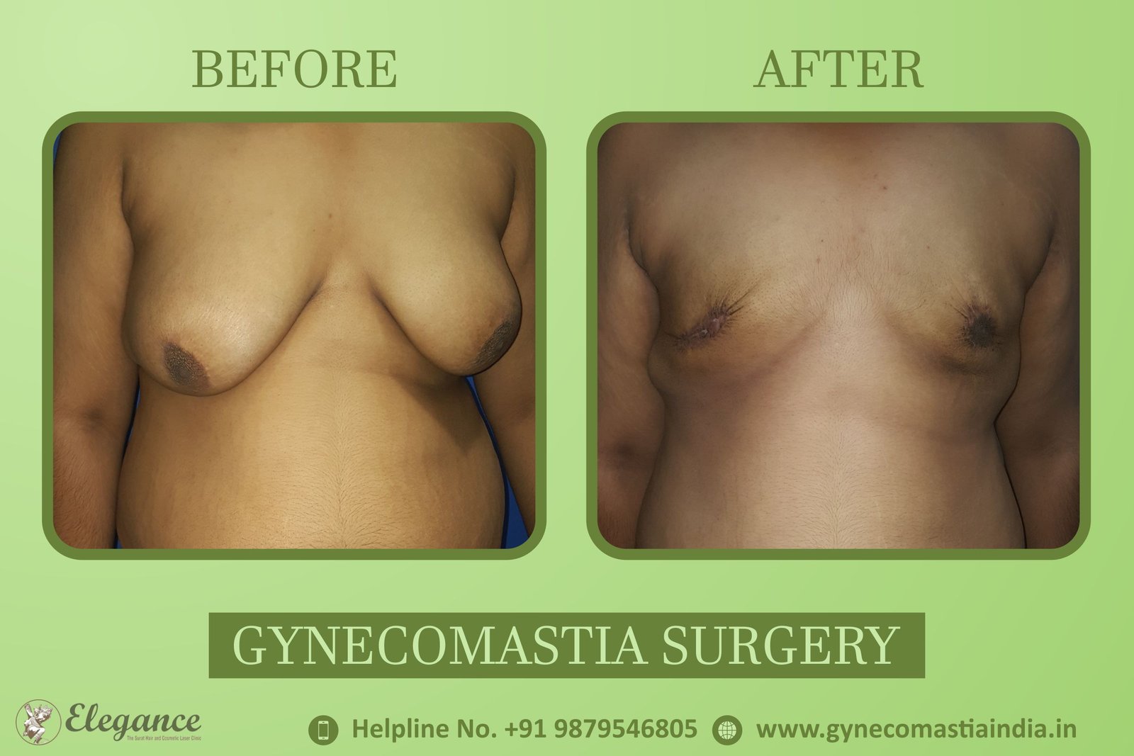 Ankleswar, Gujarat, india gynecomastia clinic