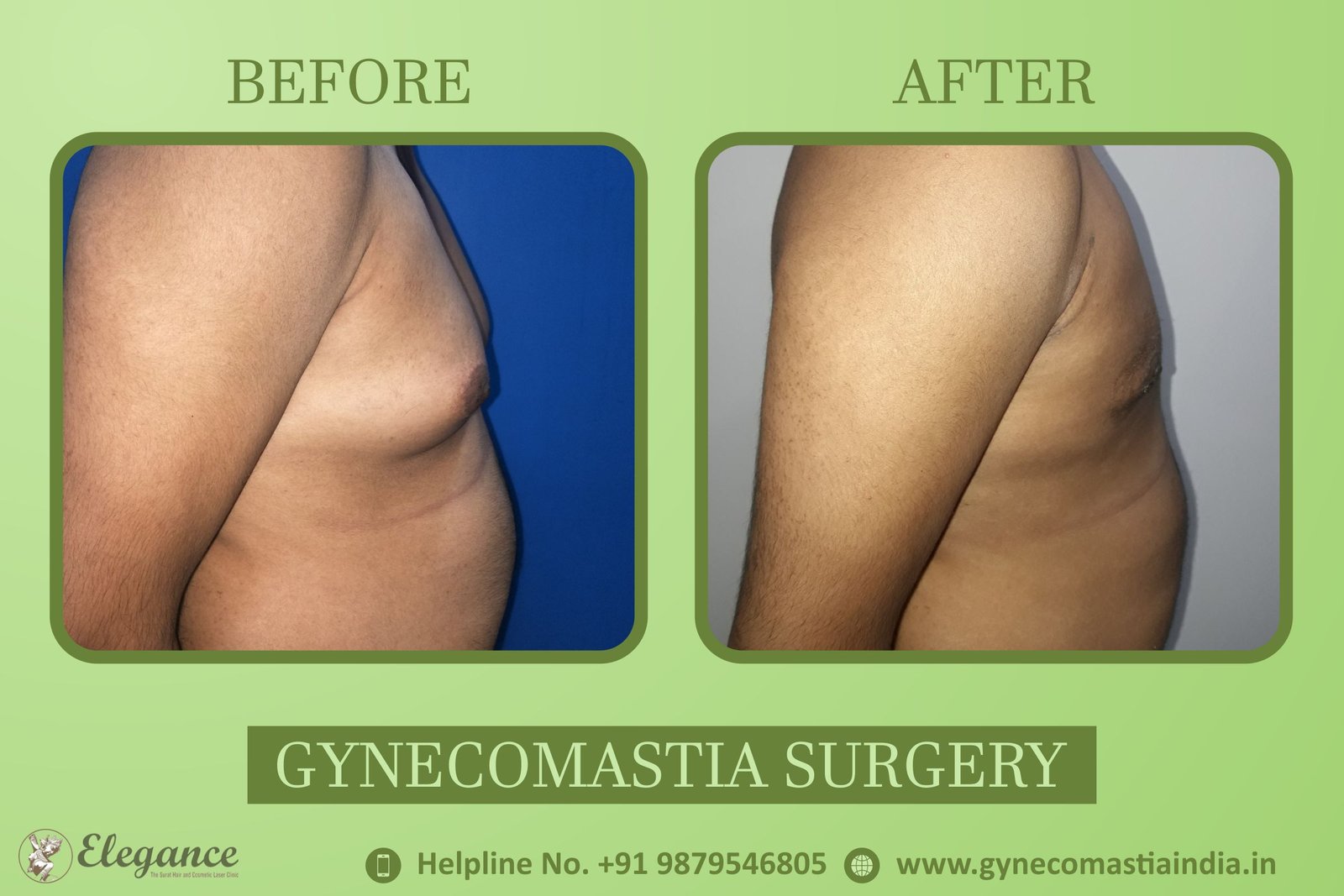 Bardoli, Gujarat, india Gynecomastia Clinic