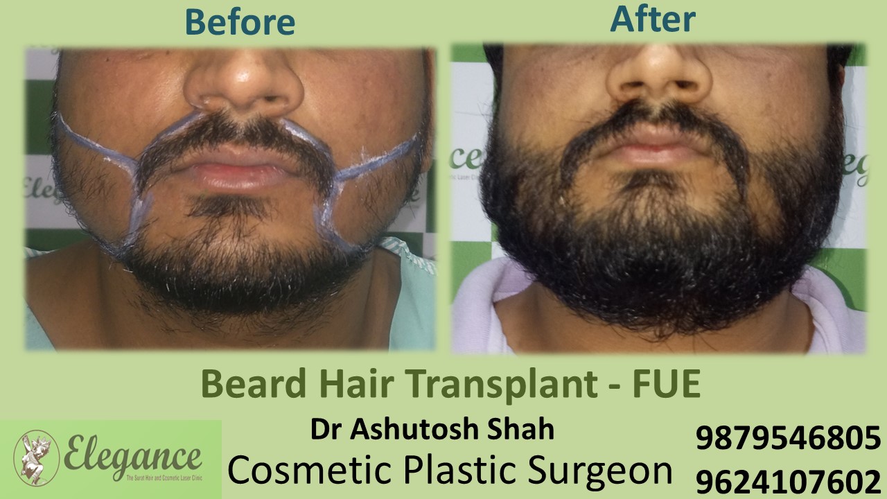 Beard Hair Transplant - FUE, Ahemdabad, Gujarat, India.