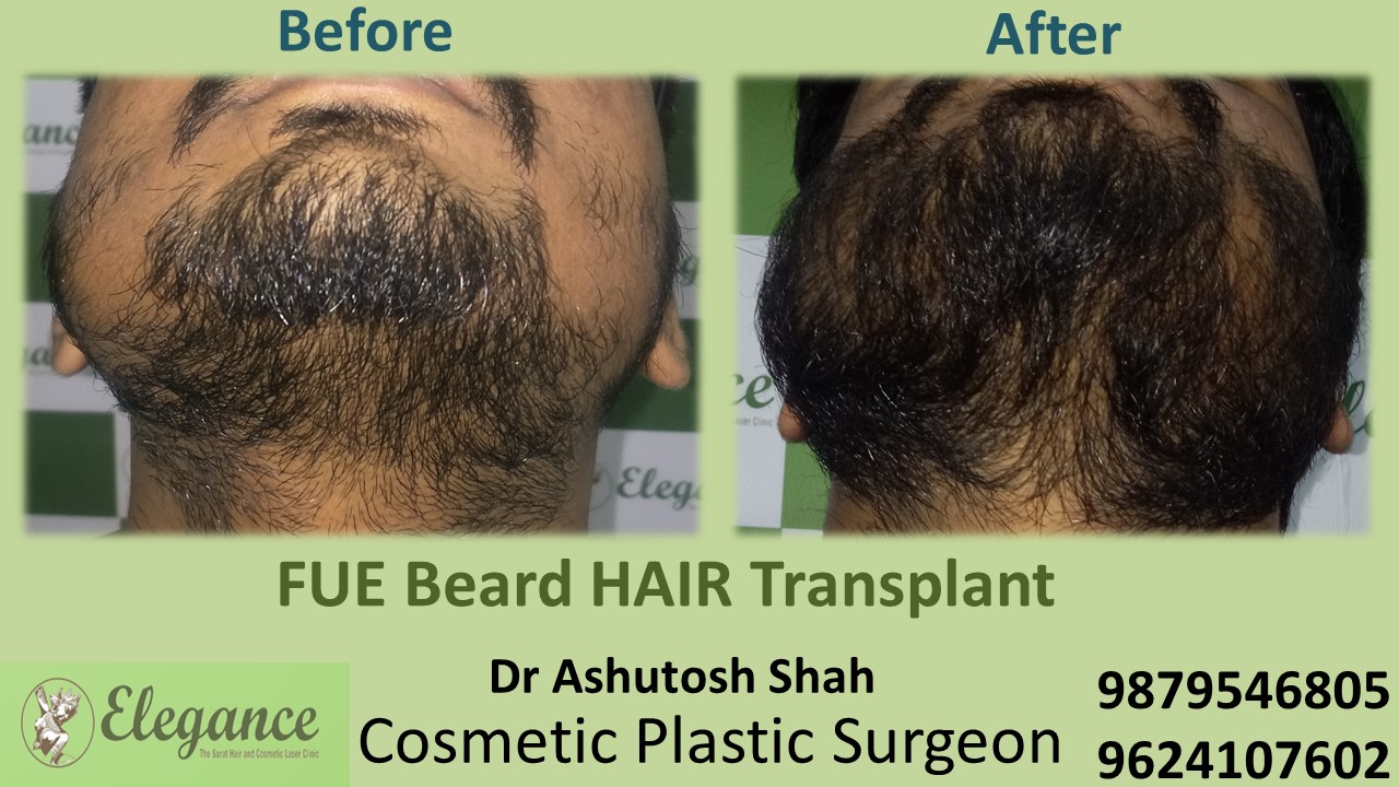 Beard Hair Transplant - FUE, Bardoli, Gujarat, India.