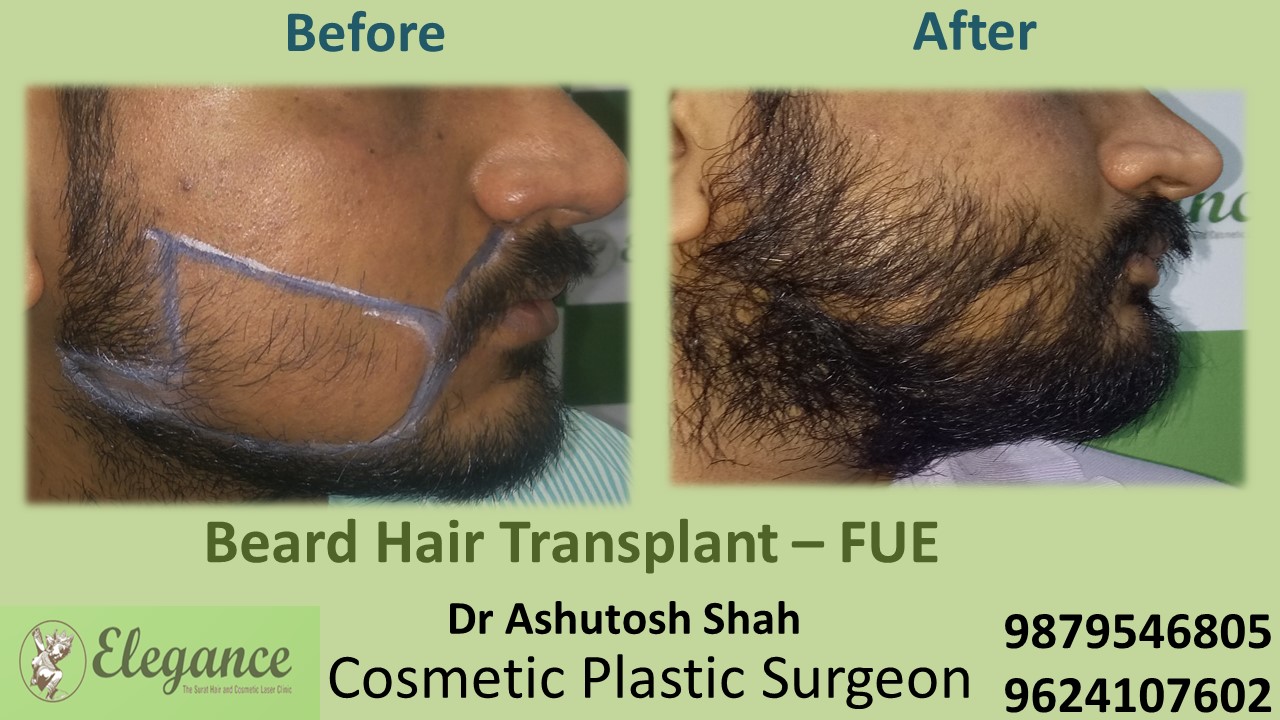 Beard Hair Transplant - FUE, Surat, Gujarat, India.