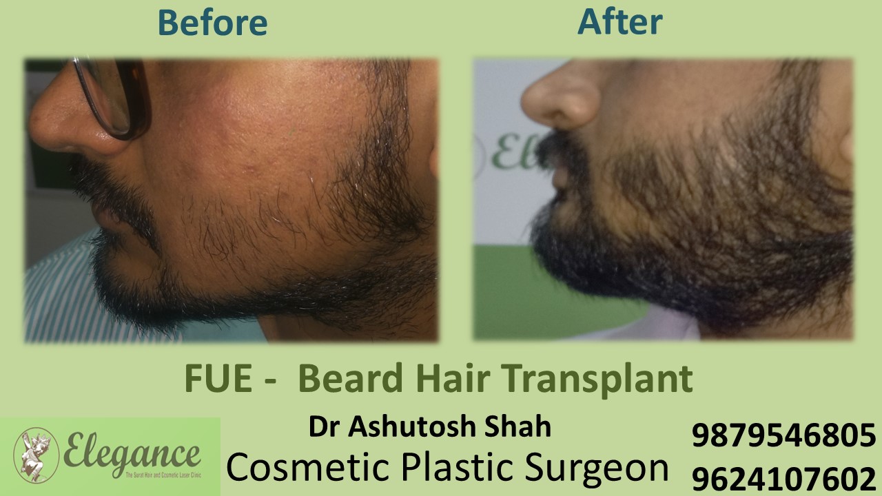 Beard Hair Transplant - FUE, Vadodara, Gujarat, India.