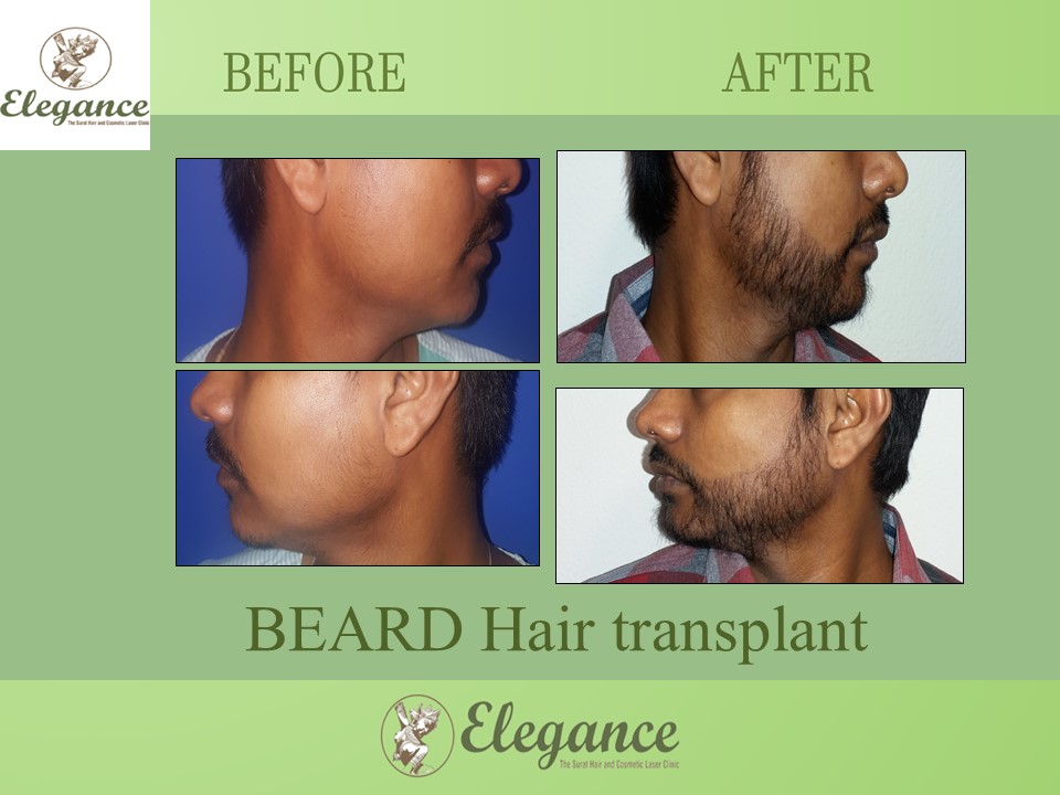 Beard Hair Transplant in Kosamba, Gujarat, India.