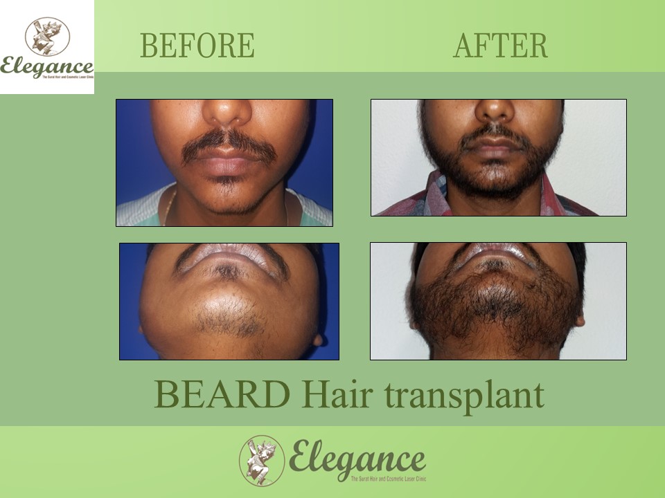 Beard Hair Transplant in Mangrol, Gujarat, India.