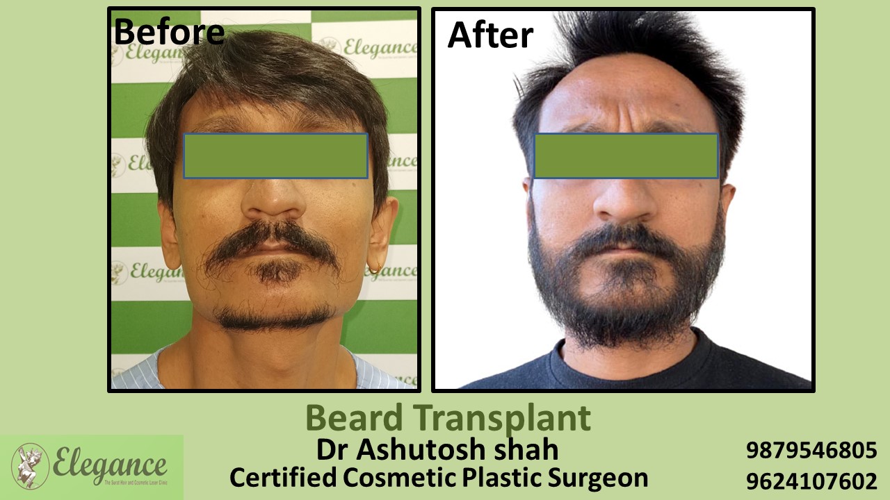 Beard Hair Transplant in Surat, Gujarat, India.