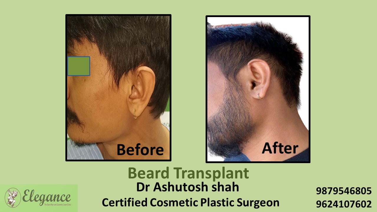 Beard Hair Transplant in Vadodara, Gujarat, India.