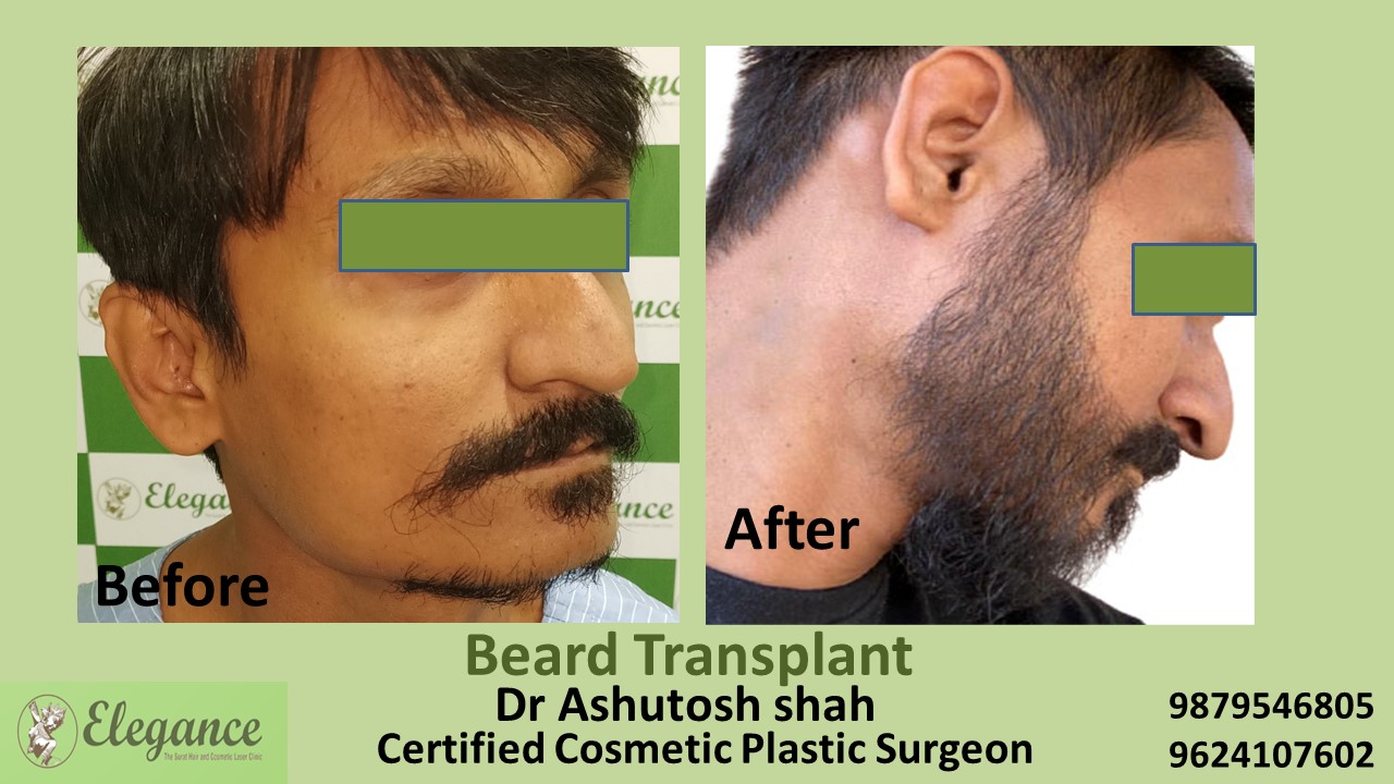 Beard Hair Transplant in Valsad, Gujarat, India.