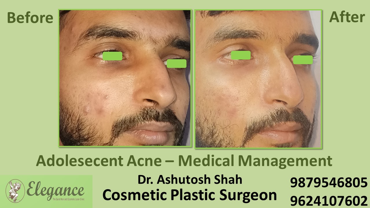 Before And After Acne Scar Results In Surat, Vapi, Valsad.