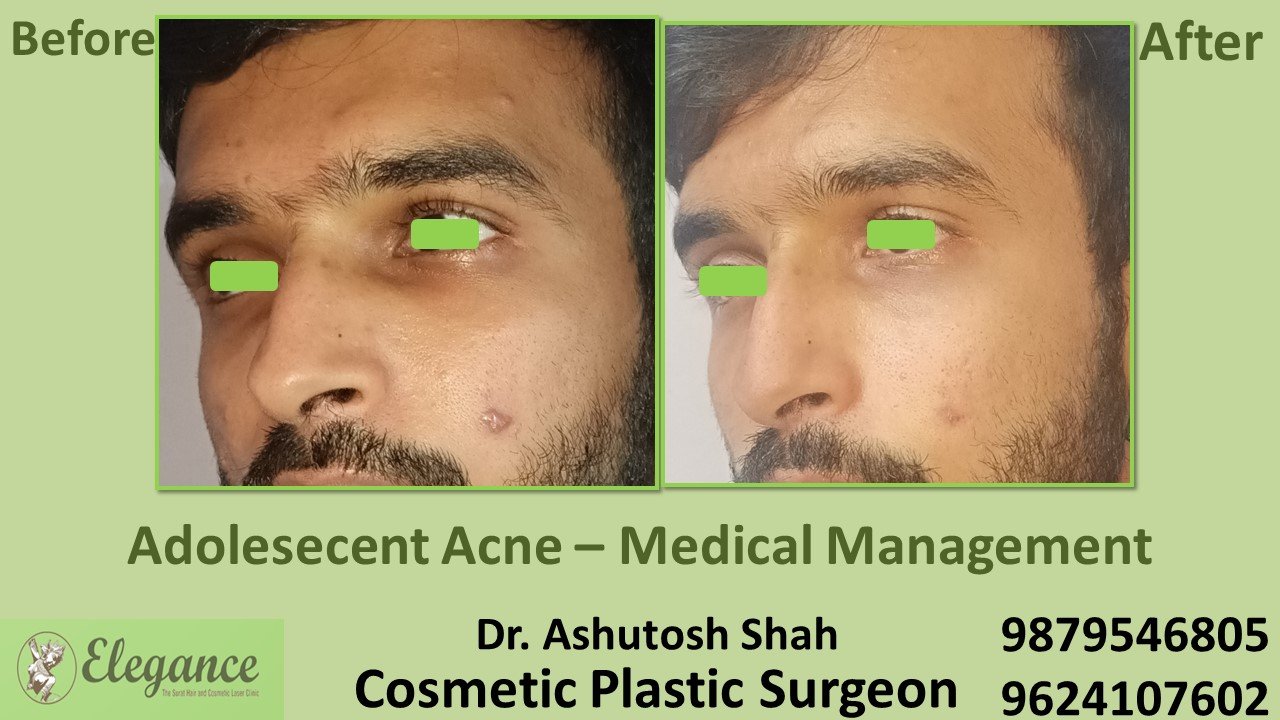 Best Acne Removal Hospital In Surat Vapi, Valsad, Bharuch.