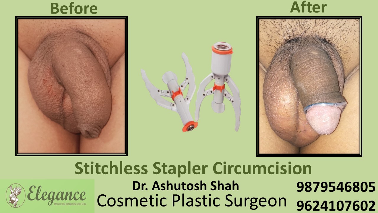 Best Doctor for Stitchless Stapler Circumcision near Ahmadabad, Gujarat
