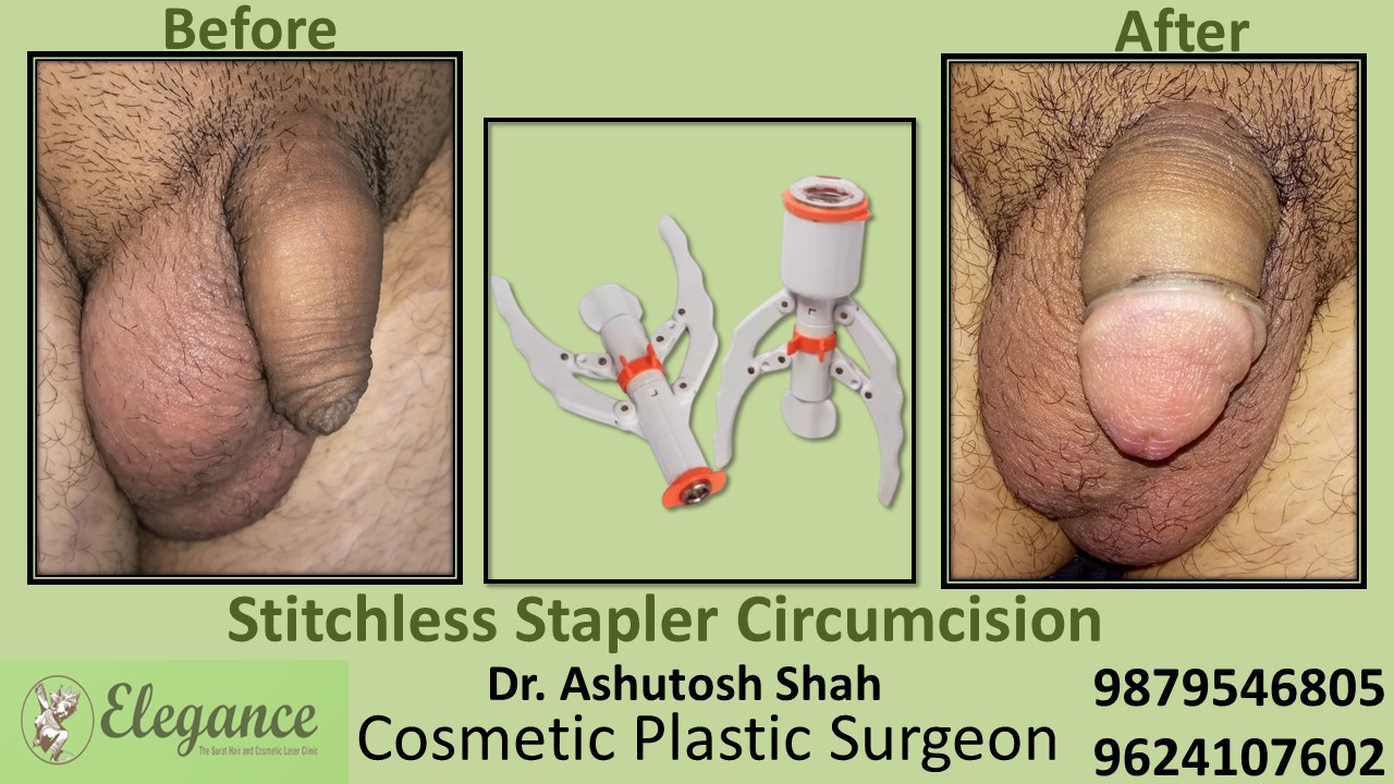 Best Doctor for Stitchless Stapler Circumcision near Amroli, Gujarat