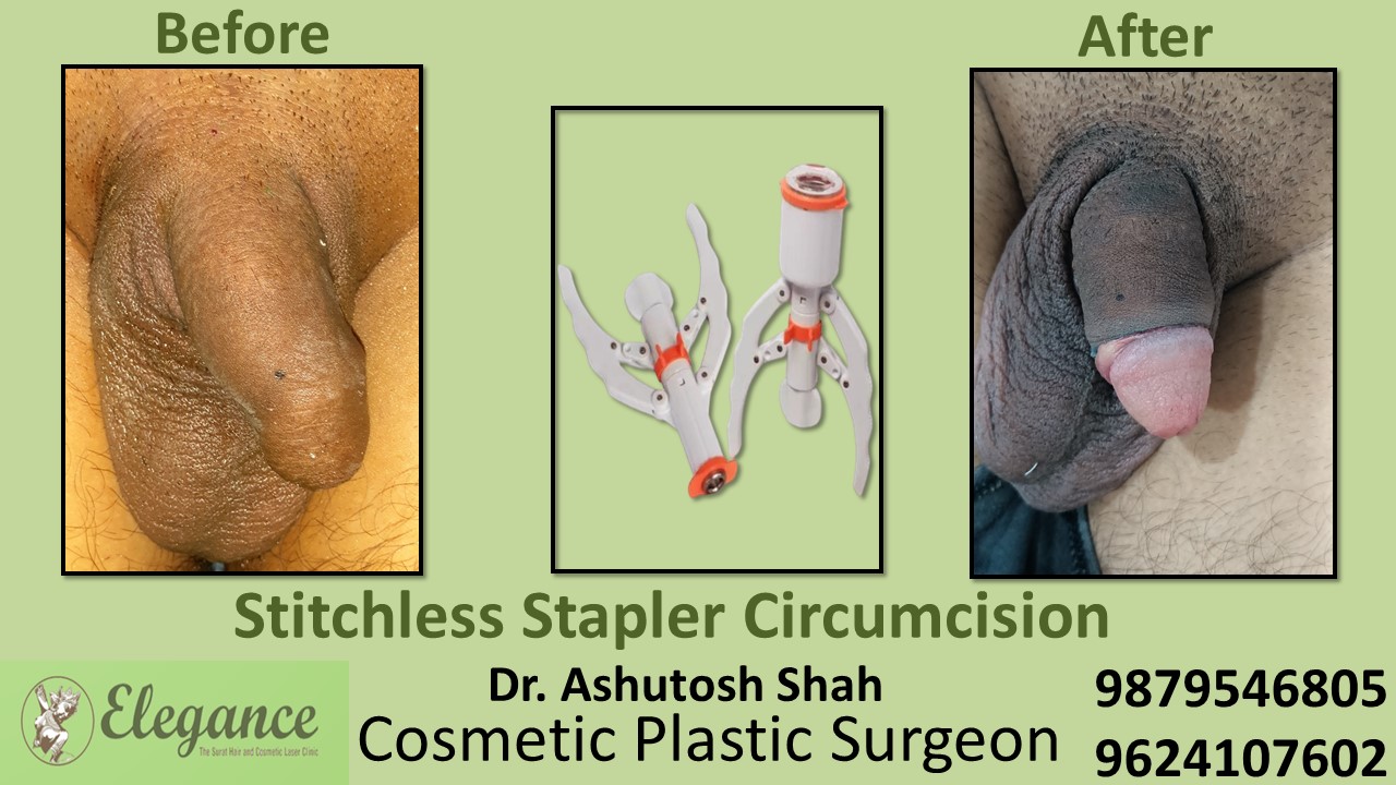 Best Doctor for Stitchless Stapler Circumcision near Ankleshwar, Gujarat