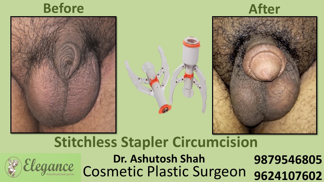Best Doctor for Stitchless Stapler Circumcision near Bharuch, Gujarat
