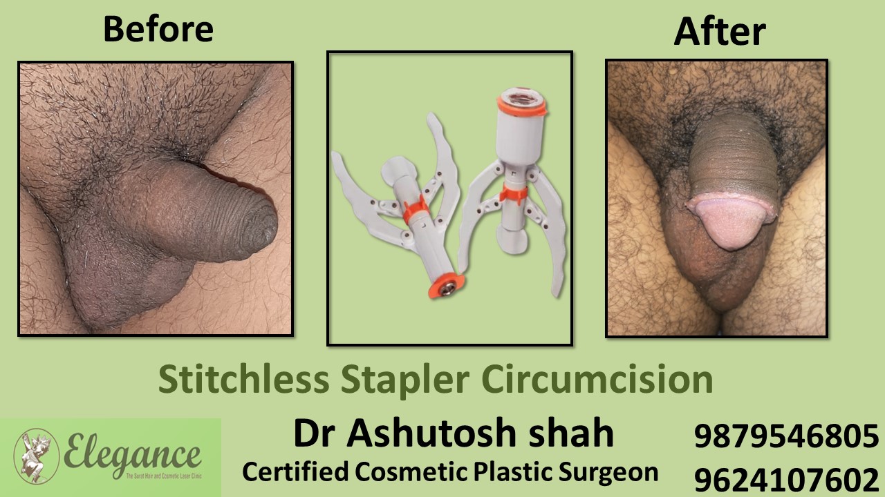 Best Doctor for Stitchless Stapler Circumcision near Navsari, Gujarat