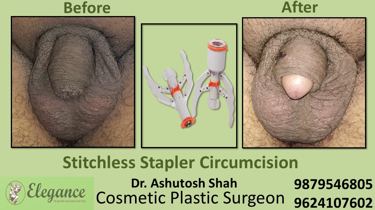 Best Doctor for Stitchless Stapler Circumcision near Vadodara, Gujarat