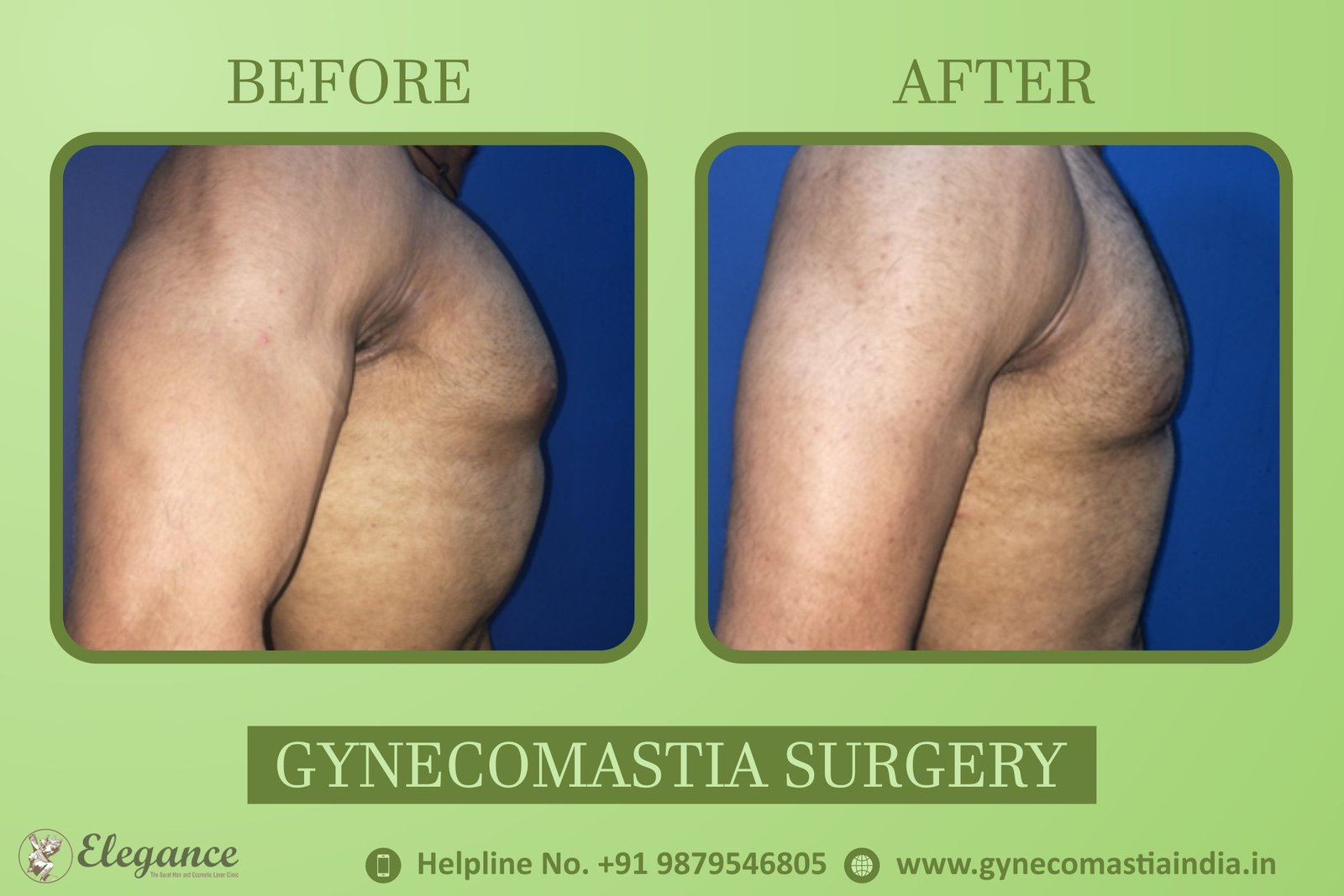 Best  Gynecomastia Surat, Gujarat, india