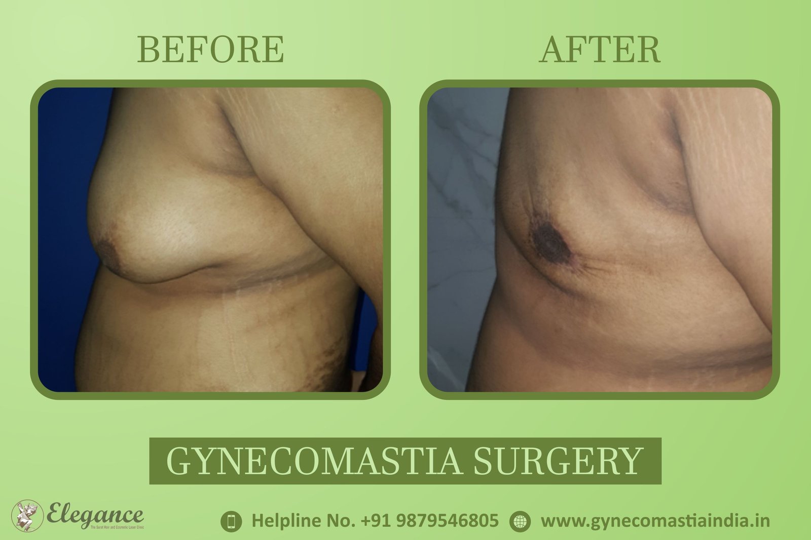 Best Gynecomastia Clinic in Ankleswar, Gujarat, india