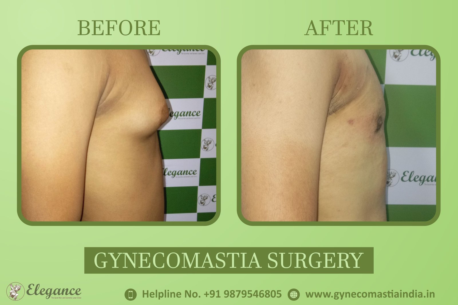 Best Gynecomastia Clinic in Surat, Gujarat, india