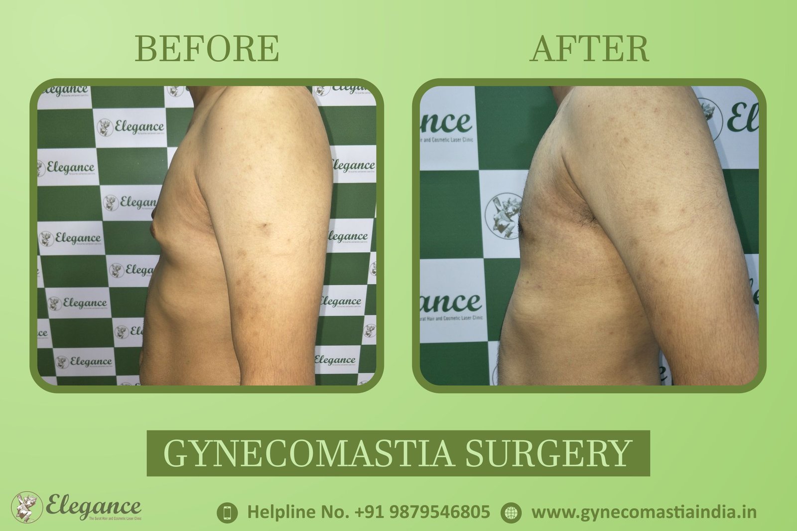 Best Gynecomastia in Surat, Gujarat, india