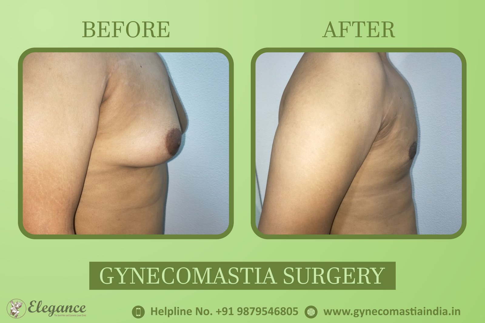 Best Gynecomastiya Doctor in Bardoli, Gujarat, india