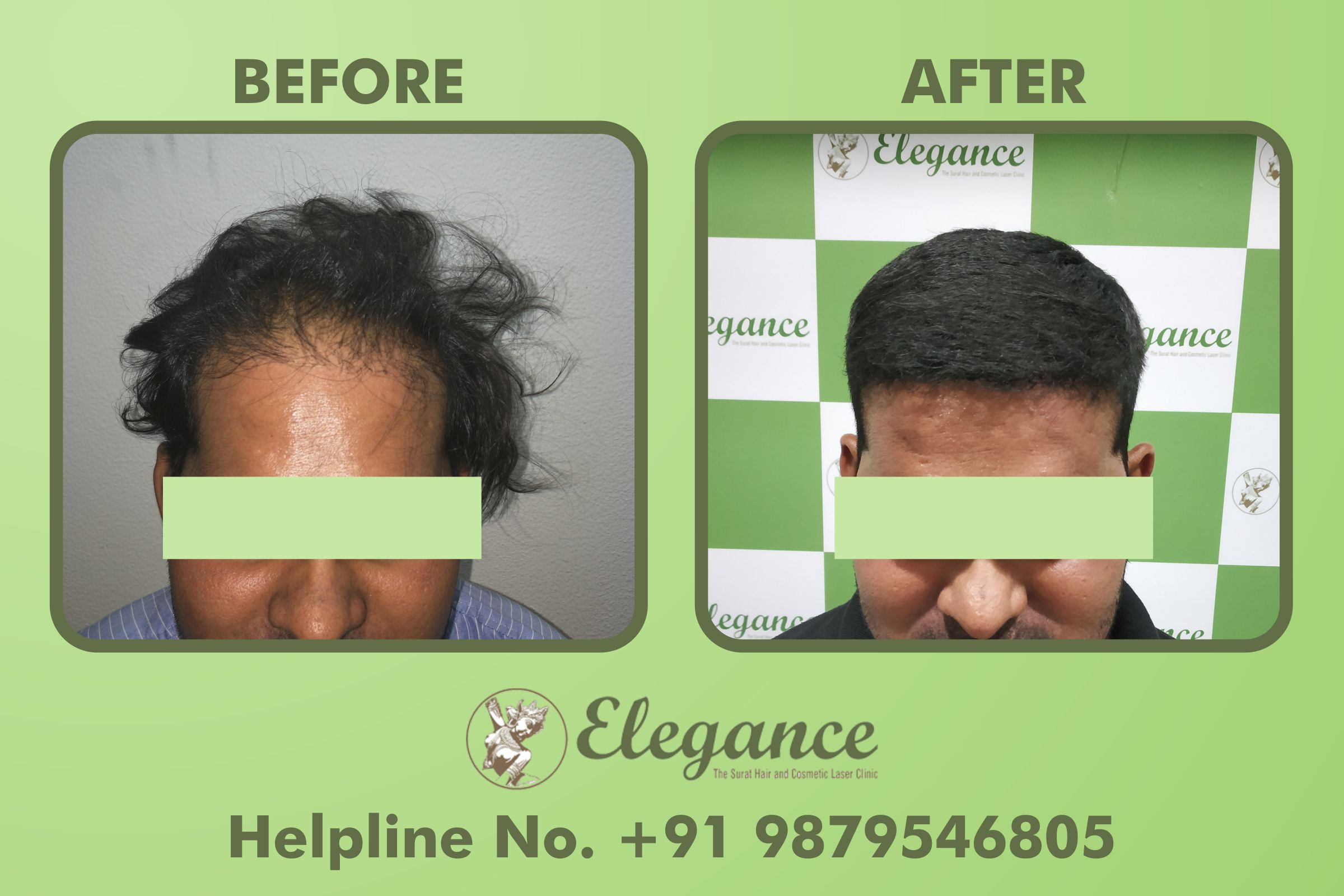Best Hair Clinic in Bharuch, Gujarat, India