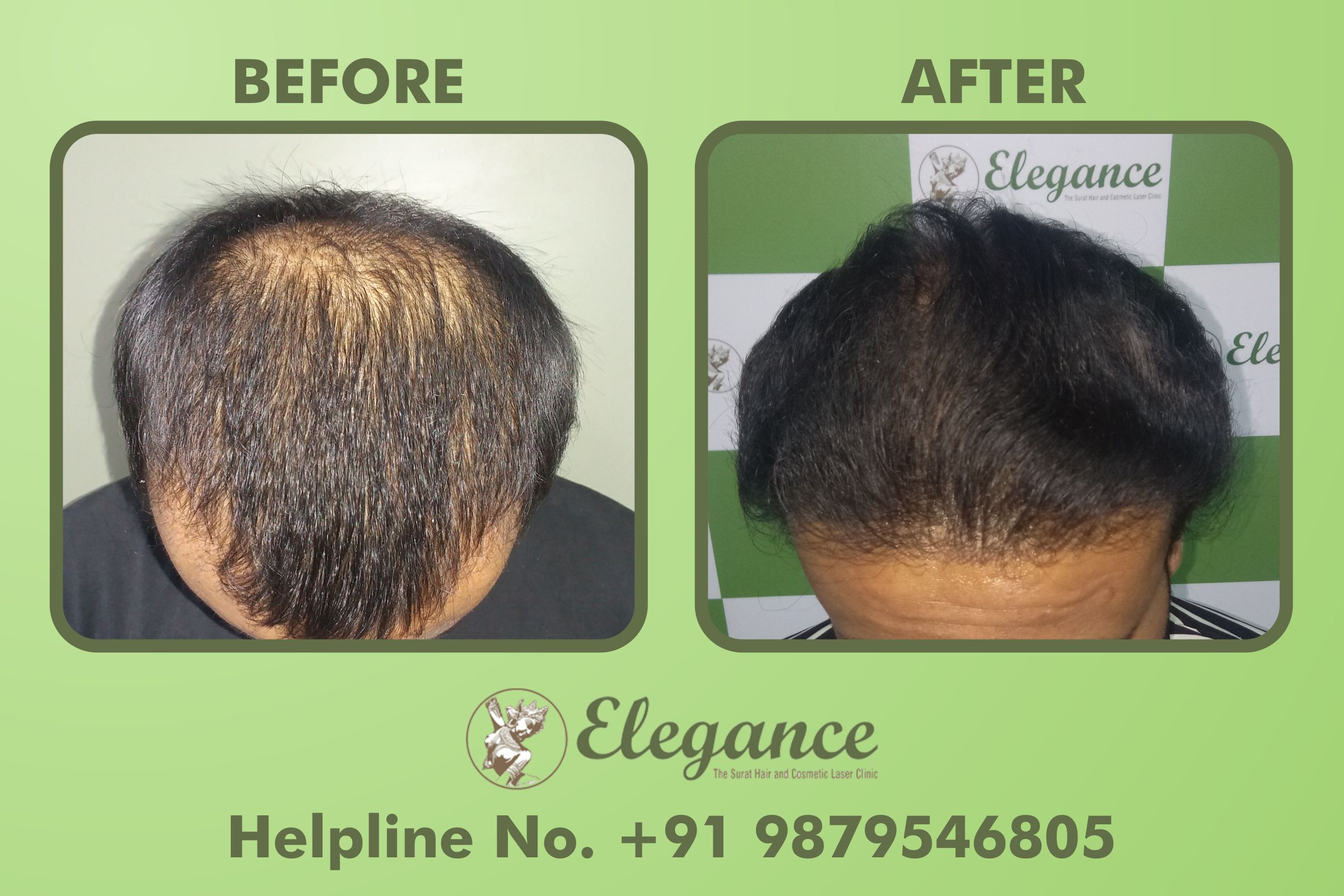 Best Hair Transplant Clinic in Bharuch, Gujarat, India