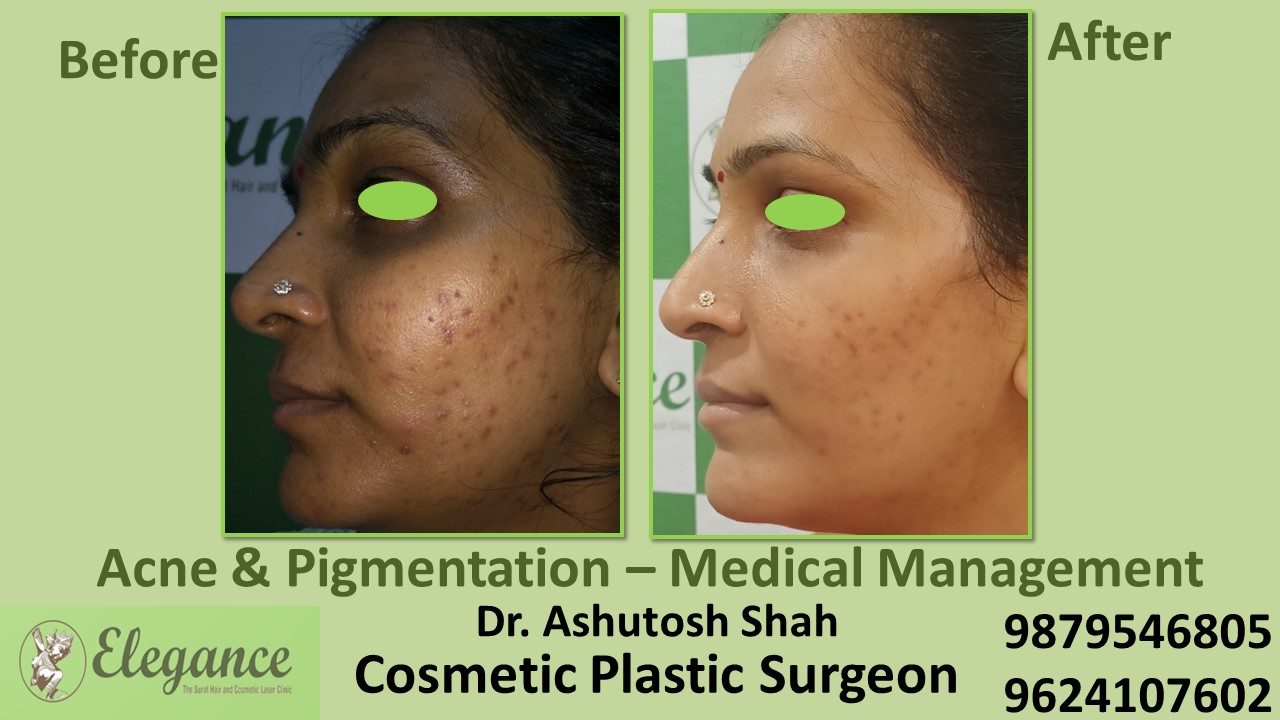 Best pigmentation Treatment In Adajan, Vesu, Piplod, Surat.