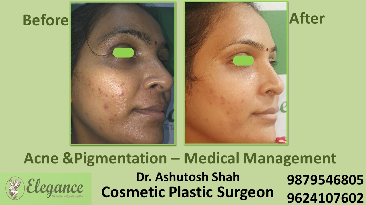 Best Result For Acne Treatment In Vesu, Althan, Adajan, Surat